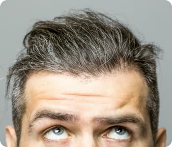 hair-loss
